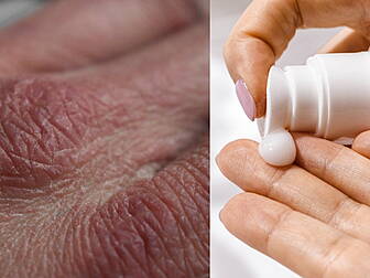 How To Manage Dry Skin This Wi...
